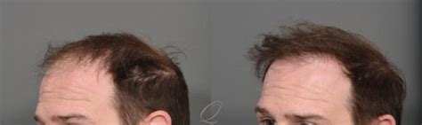 Male Fue Hair Transplant Before After Photos Patient