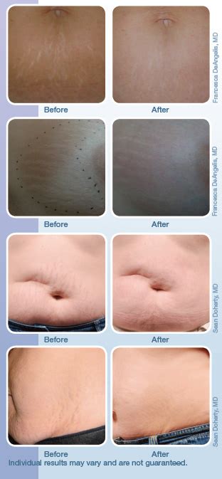 The Non Surgical Approach To Stretch Mark Treatment That Youve Been