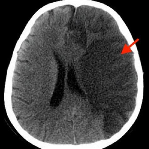 Head Ct Without Contrast Parenchymal Low Attenuation In The Left