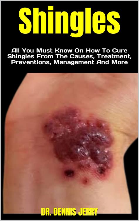 Shingles All You Must Know On How To Cure Shingles From The Causes