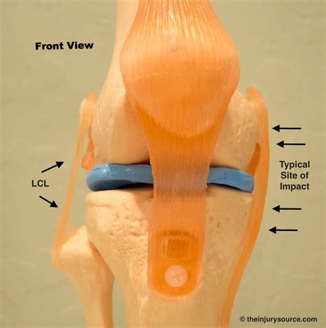 Isolated Lcl Lateral Collateral Ligament Injury