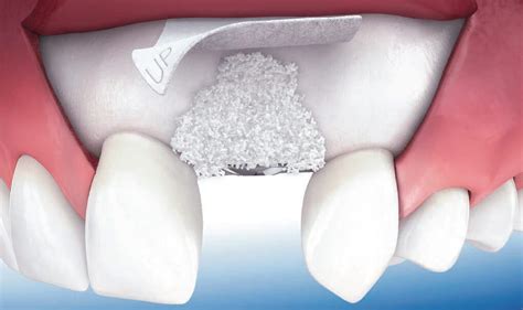Discover If A Bone Graft Is The Right Procedure For You