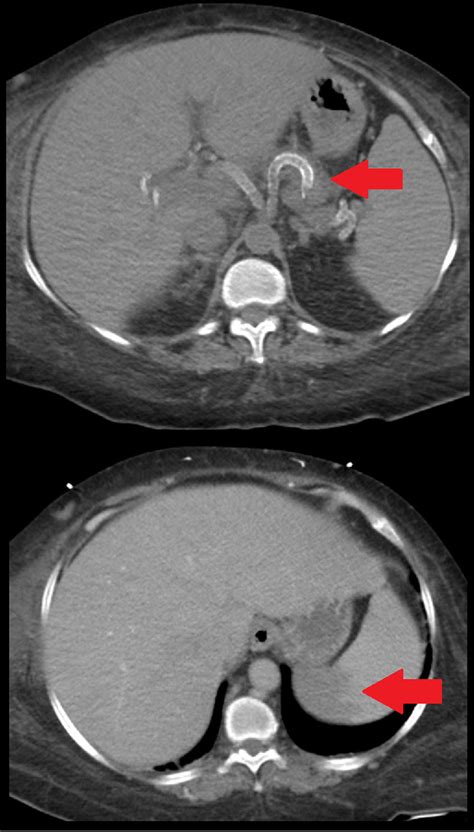 Ct Abdomen With Contrast Showing Two Transverse Views Red Arrow