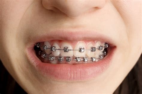 swollen gums with braces