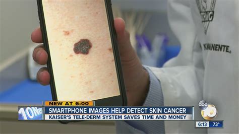 Smartphone Images Help Detect Skin Cancer Youtube