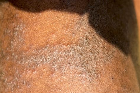 The Link Between Psoriasis And Hiv Ucsf