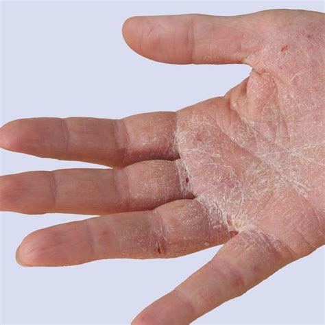 Mix · Dyshidrotic Eczema Aka Itchy Hands And Feet Tips To Prevent