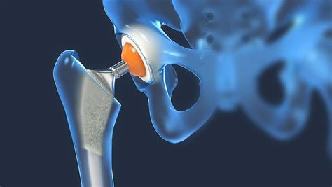 Driving After Hip Replacement Orthopedic Surgeon