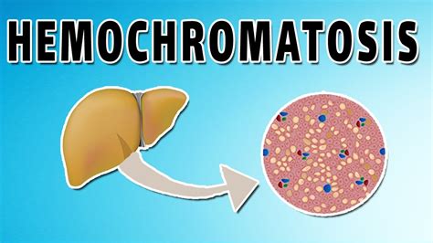 Hemochromatosis Causes Symptoms And Treatment Youtube