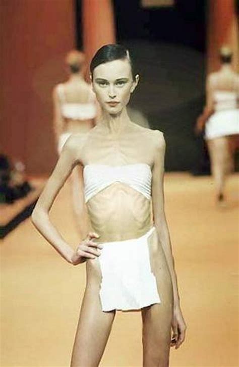 Anorexia Anorexic Models