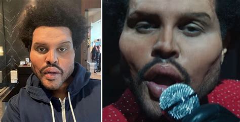 Did The Weeknd Have Plastic Surgery