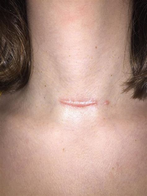 A Hypertrophic Or Keloid Scar From A Thyroidectomy Stock Image Image