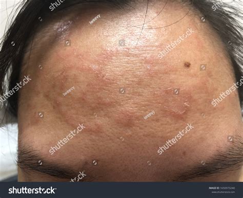 Tinea Faciei Skin Infection On Face Stock Photo 1650973240 Shutterstock