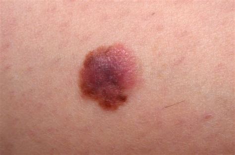 Melanoma Pictures Getty Images