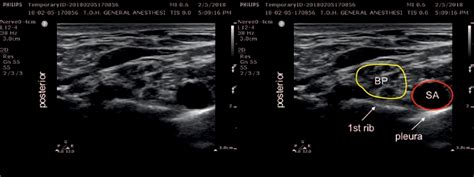 Ultrasound Guided Interscalene Brachial Plexus Nerve Block Nysora Porn Sex Picture