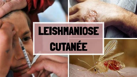 La Leishmaniose CutannÉ Causes Sypmtomes Complications