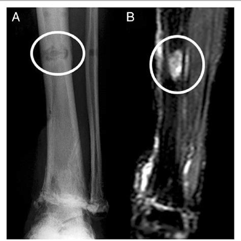 Anteroposterior View Of An Osteolytic Lesion Plain Radiography Shows