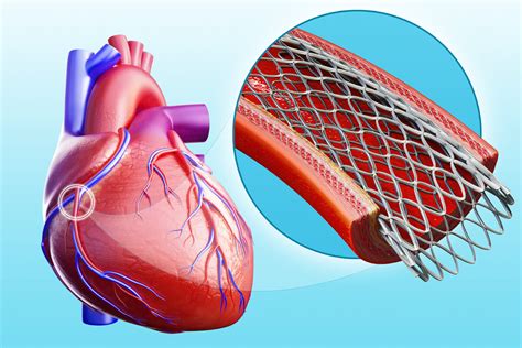 Heart Stent Procedure Videos For Blocked Operation