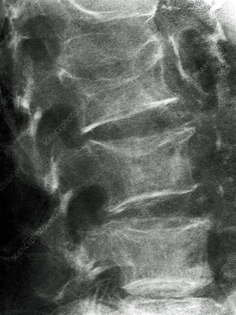 Osteoporosis X Ray Stock Image C0272190 Science Photo Library