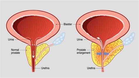 Benign Prostatic Hyperplasia Symptoms Causes And Treatments Rescue Urology Hospital Blog