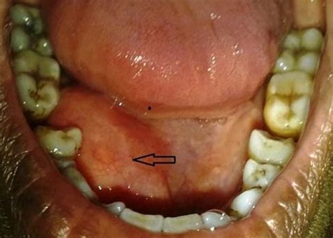 Bilateral Floor Of Mouth Swelling Viewfloor Co