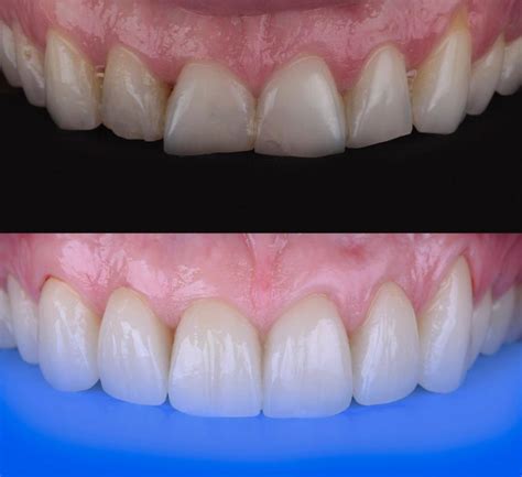 Mockup Dental En El Diseño De Sonrisas Clínica Odontológica Everest
