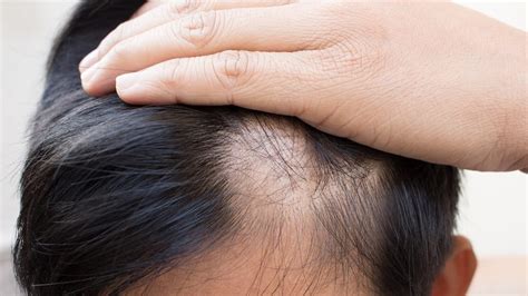 Alopecia Areata O Que Causas Sintomas E Tratamento The Best Porn Website