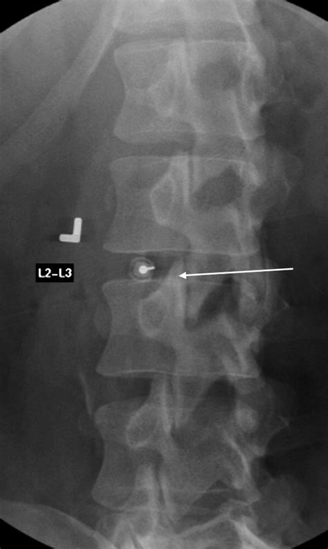 Lumbar Discography Radiologic Clinics