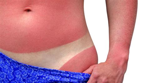 Sunburn Treatment After Sun Skin Care