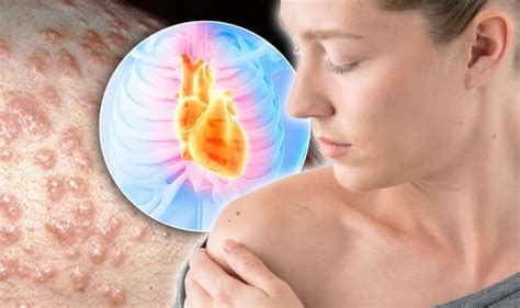 Heart Attack Symptoms Signs Of Heart Disease Include Skin Bumps