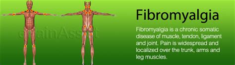 Fibromyalgia Explained Causes Symptoms Treatment Prognosis