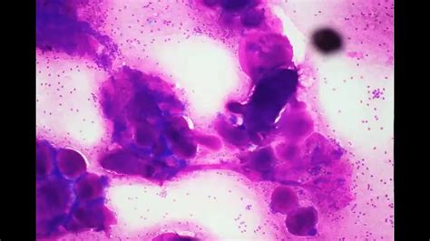 Adenoid Cystic Carcinoma Cytology Youtube