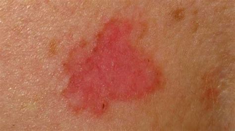 Exquis Gril La Pollution Red Spot On Leg Skin Cancer Compétence De Rayé