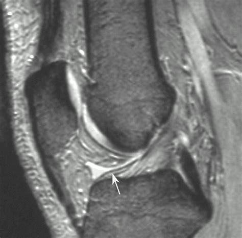 Anatomy And Mr Imaging Appearances Of Synovial Plicae Of The Knee