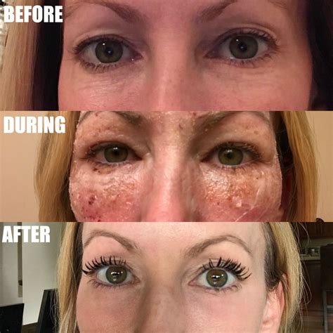 Laser For Under Eye Wrinkles Before And After