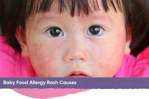 Baby Food Allergy Rash Causes Symptoms And Natural Treatments