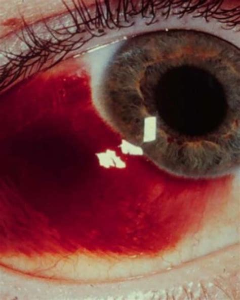 Causes Of A Red Spot On Eye Youmemindbody