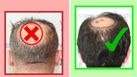 Signs You Are A Good Hair Transplant Candidate Youtube