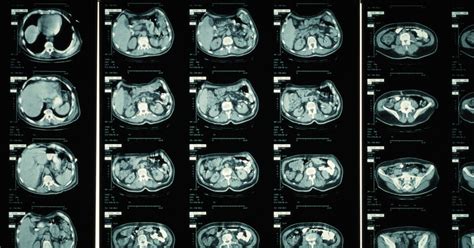 What Is A Ct Scan What The Test Detects And How It Works