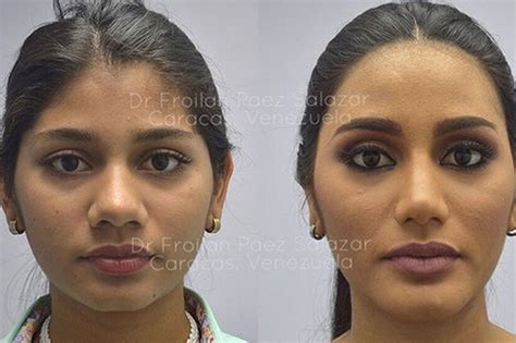 Classify Miss Venezuela 2017 Before The Plastic Surgery