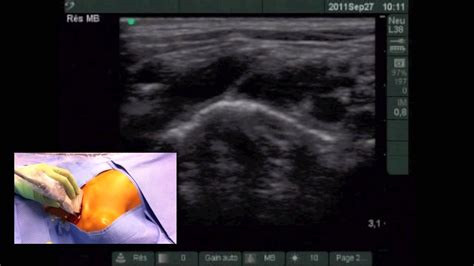 Ultrasound Guided Supraclavicular Subclavian Vein Catheterization In