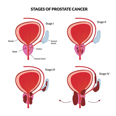 Prostate Cancer Stages Symptoms Cancerwalls