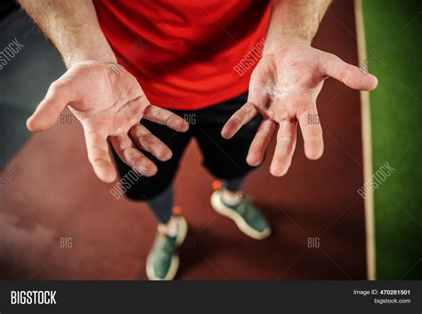 Palms Blisters Image And Photo Free Trial Bigstock