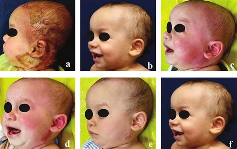 A 1 Year Old Boy With Superficial And Deep Dermal Burns To The Face
