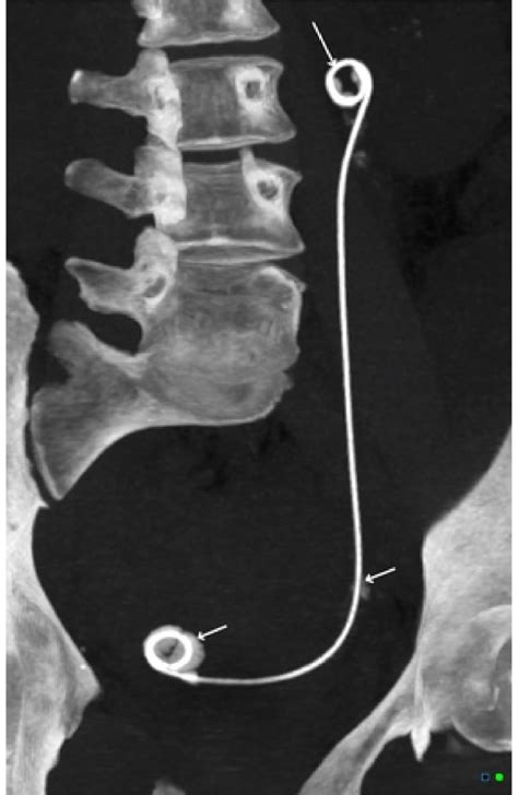 A Coronal Ct Image Of A Ureteric Stent In Situ Showing Encrustations