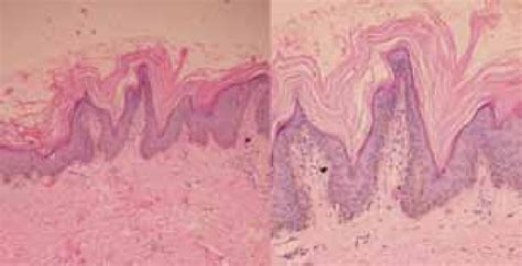 Skin Biopsy Showing Hyperkeratotic Epidermis With Papillomatosis And