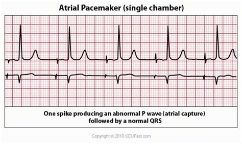 Atrial Pacemaker Rhythm Strip Nursing Pinterest