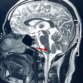 Sagittal T Weighted Mri Showing A Cavernoma In The Dorsal Medulla Download Scientific Diagram