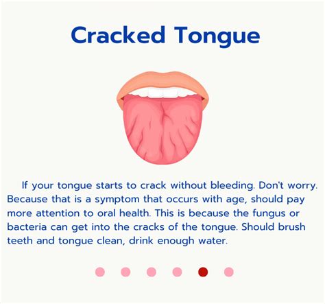Did You Know Tongue Can Tell Disease Chiangmai Hospital Tel 053 225 222