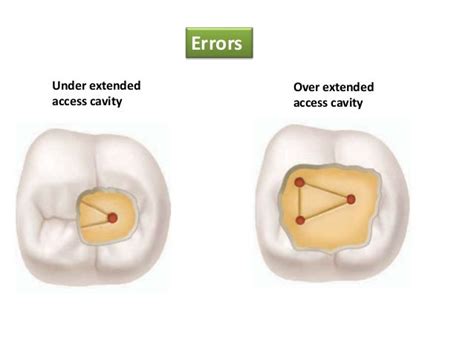 Access Cavity Preparation